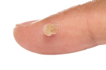 使用Skincell亲在那种情况下，如果你有皮肤上的斑点，摩尔，疣、年龄有关的皮肤变化