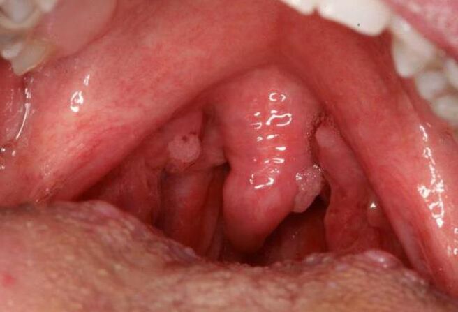 喉咙里的乳头状瘤