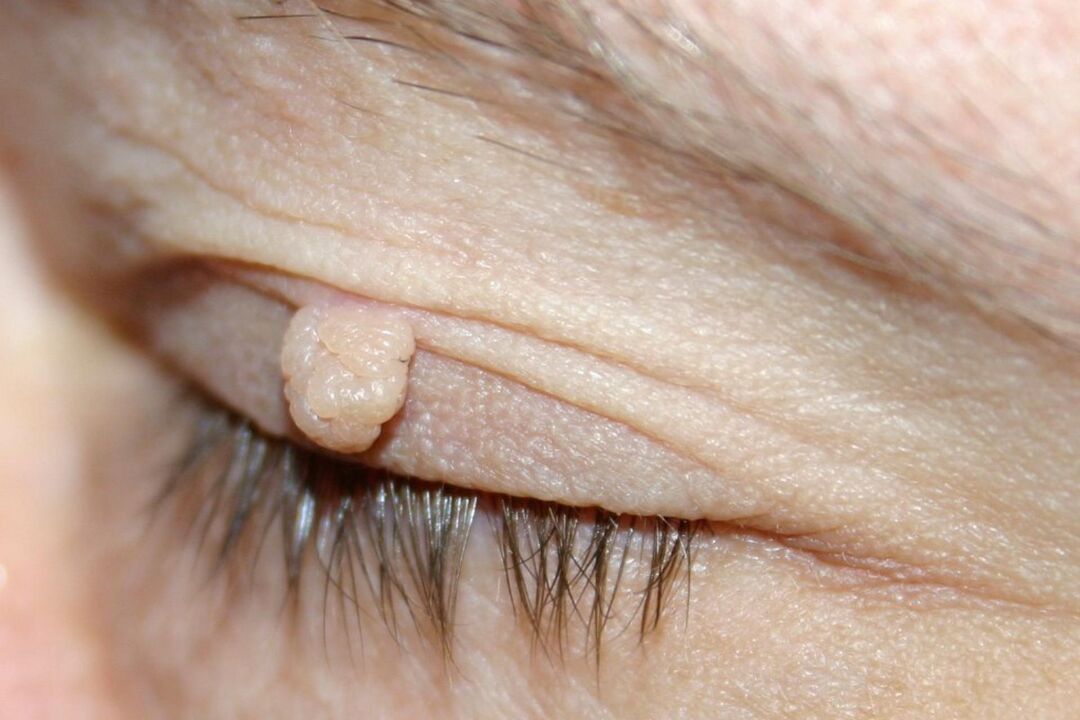 眼睑乳头状瘤的症状