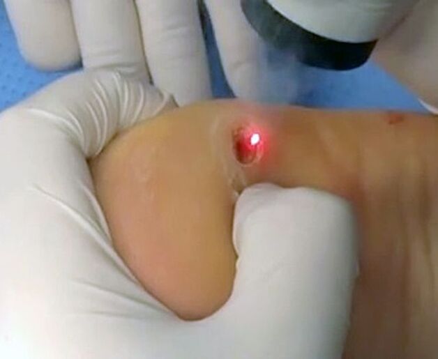 用激光去除脚后跟疣的过程